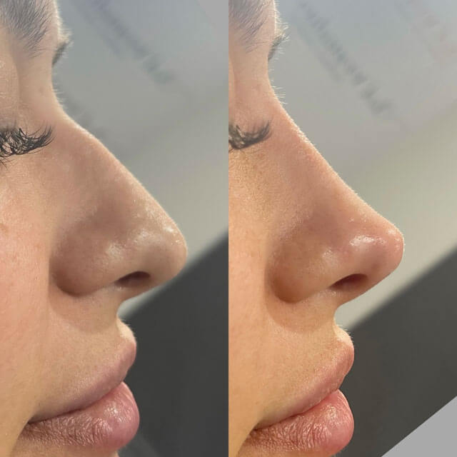 non-surgical rhinoplasty before and after