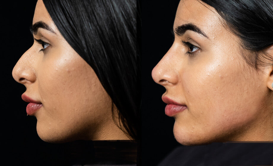 non-surgical rhinoplasty before and after