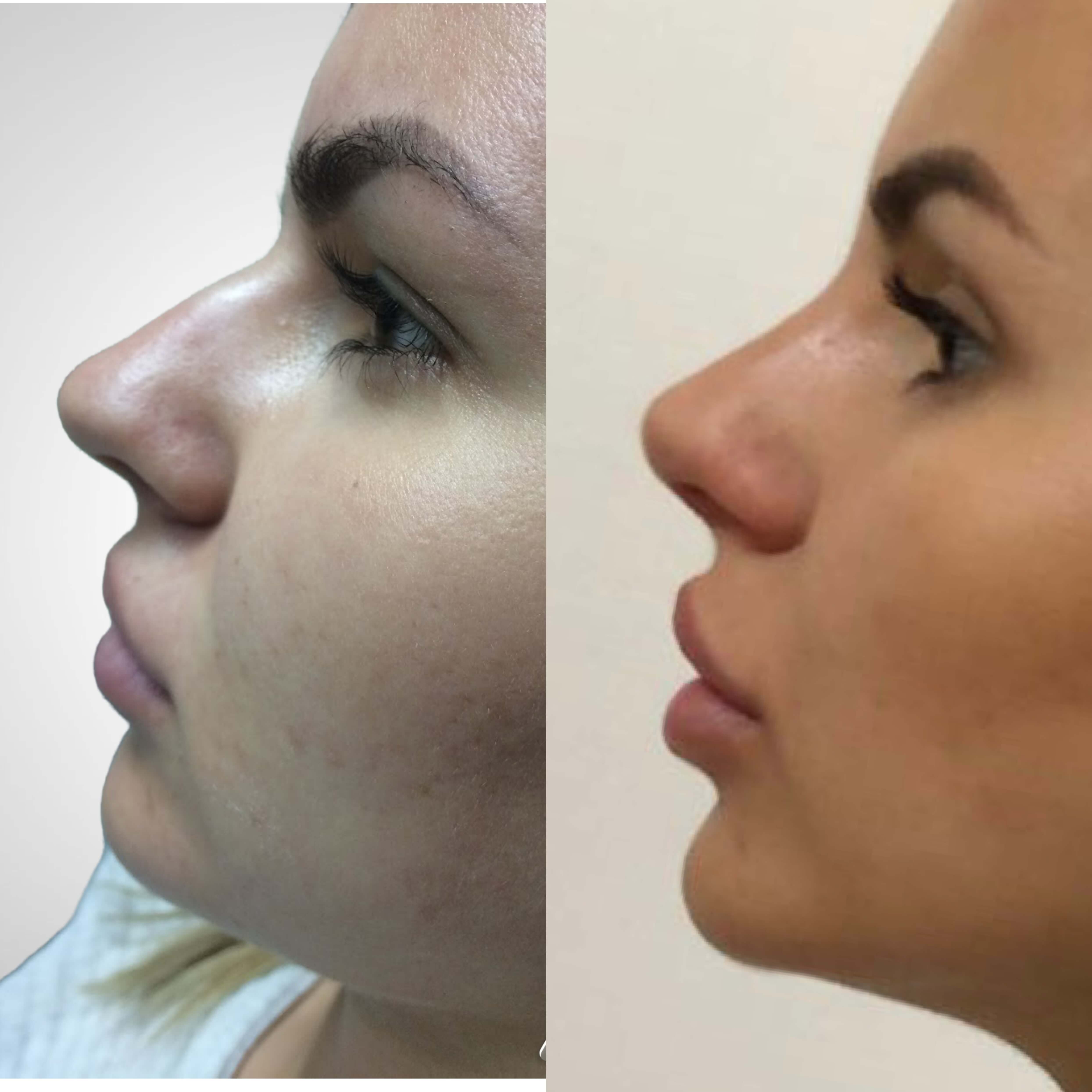 non-surgical rhinoplasty before and after