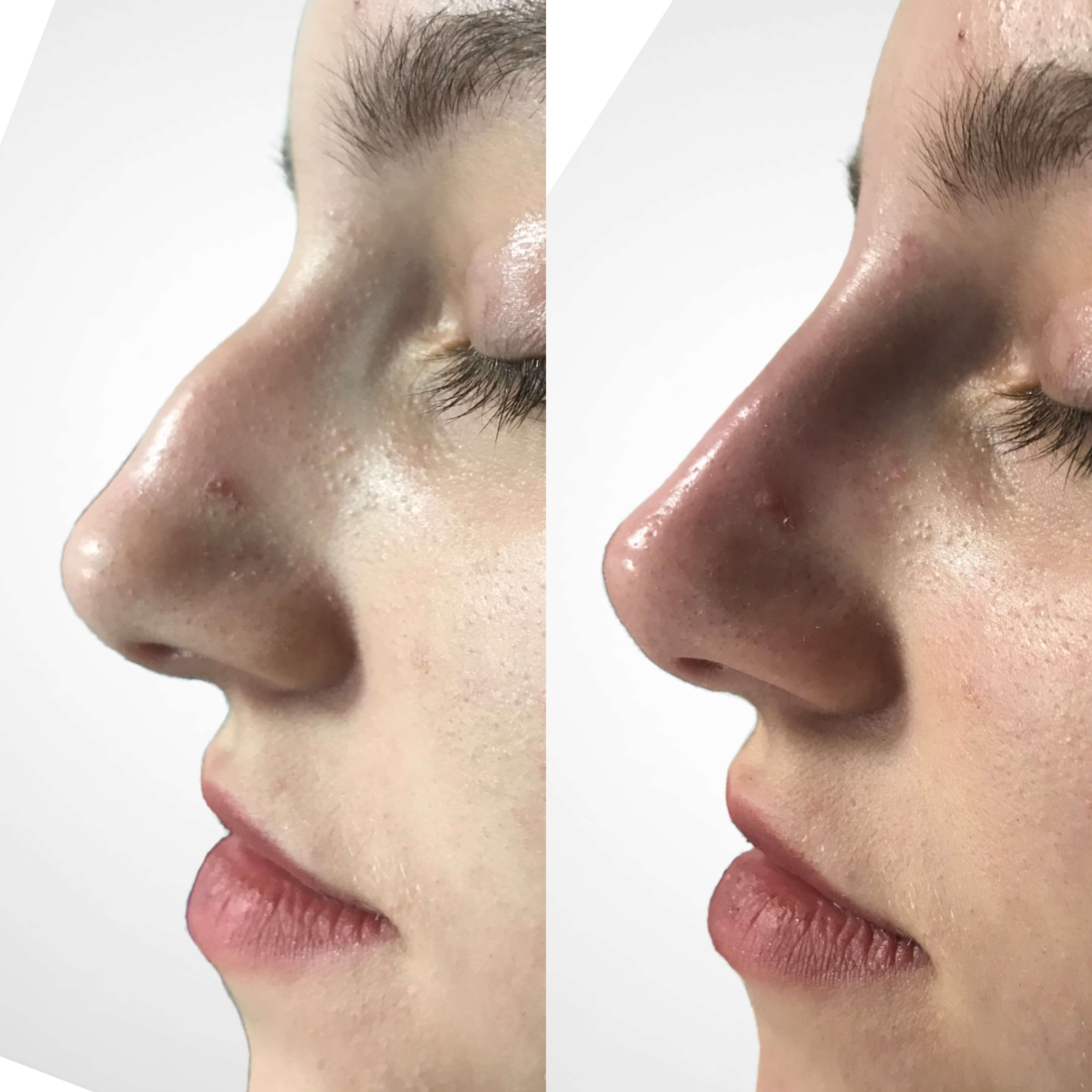 non-surgical rhinoplasty before and after